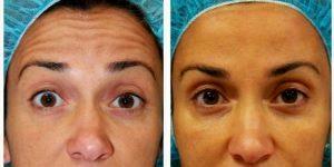 41 Year Old Female Treated With Botox For Forehead Lines Before And After With Doctor Shaun Patel, MD, Miami Physician
