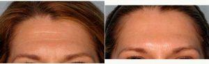41 Year Old Woman Treated With Botox Results By Dr. Joseph A. Eviatar, MD, FACS, New York Oculoplastic Surgeon