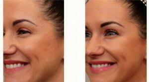 41 Year Old Woman Treated With Botox With Dr Connie Hiers, MD, San Antonio Plastic Surgeon