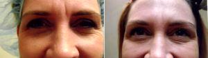 41 Year Old Woman Treated With Botox for A Furrowed Brows With Doctor Florencia Guzman, MD, West Chester Physician