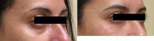 41 Year Old Woman Treated With Restylane Before & After With Dr. Elham Jafari, MD, Irvine Physician