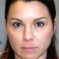 41 Year Old Woman Treated With Restylane With Doctor Robert W. Sheffield, MD, Santa Barbara Plastic Surgeon
