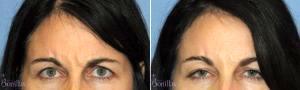 42 Y O Female Desired A Refreshed Look. With Dr Robert G. Bonillas, MD, Scottsdale Plastic Surgeon