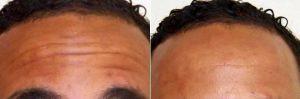 42 Year Old Man Treated With Botox For Forehead Lines By Dr Deborah Sillins, MD, Cincinnati Plastic Surgeon