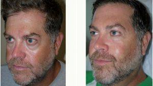 42 Year Old Man Treated With Voluma By Doctor Hayley Brown, MD, FACS, Las Vegas Plastic Surgeon