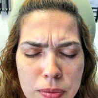 42 Year Old Woman Treated With Botox Before And After By Doctor Angela J. Lamb, MD, New York Dermatologist