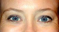 42 Year Old Woman Treated With Botox Before And After By Doctor Robert W. Sheffield, MD, Santa Barbara Plastic Surgeon