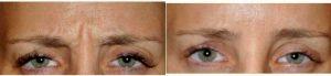 42 Year Old Woman Treated With Botox By Dr Jacquelyn Dosal, MD, Miami Dermatologic Surgeon