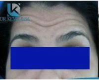 42 Year Old Woman Treated With Botox By Dr Kemil Issa, MD, Dominican Republic Plastic Surgeon