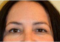 42 Year Old Woman Treated With Dysport Before & After By Dr Ana Carolina Victoria, MD, Miami Oculoplastic Surgeon