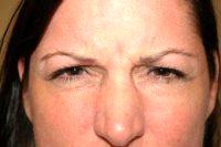 42 Year Old Woman Treated With Dysport For Glabeller Lines Brow Lift Before & After By Dr. Katherine A. Lane, MD, South Burlington Oculoplastic Surgeon