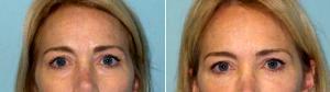 42 Year Old Woman Treated With Restylane, Botox With Doctor David Schlessinger, MD, Long Island Oculoplastic Surgeon