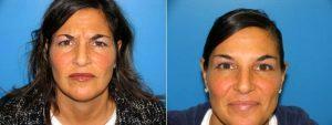 42 Yr Old Woman For Botox By Doctor William LoVerme, MD, Boston Plastic Surgeon