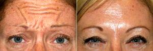 43 Year Old Woman Treated For Frown Lines Results By Doctor Peterson Pierre, MD, Thousand Oaks Dermatologist