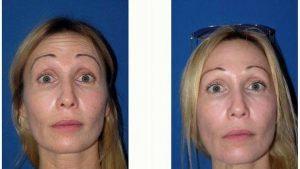43 Year Old Woman Treated With Botox And Restylane With Dr John Diaz, MD, Beverly Hills Plastic Surgeon