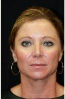 43 Year Old Woman Treated With Botox By Doctor Kris M. Reddy, MD, FACS, West Palm Beach Plastic Surgeon