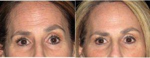 43 Year Old Woman Treated With Botox For Forehead Wrinkles By Doctor Don W. Griffin, MD, Nashville Plastic Surgeon
