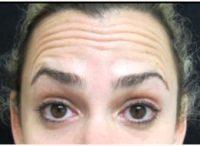 43 Year Old Woman Treated With Botox With Doctor Joshua Lampert, MD,FACS, Miami Plastic Surgeon