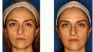 43 Year Old Woman Treated With Botox With Dr. P. Alexander Ataii, MD, San Diego Physician