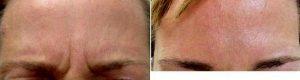 43 Year Old Woman Treated With Botox for A Furrowed Brows By Dr. Anita Arora Gill, MD, The Woodlands Dermatologic Surgeon
