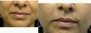 43 Year Old Woman Treated With Juvederm Before & After With Dr Timothy Mountcastle, MD, Ashburn Plastic Surgeon