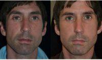 44 Year Old Man Treated With Botox Anti Wrinkle Injections In The Face With Dr Tracey Bell, BDS, Great Britain Dentist