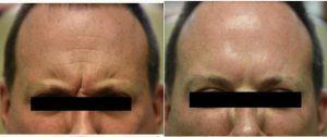 44 Year Old Man Treated With Botox By Dr Peter N. Butler, MD, Pensacola Plastic Surgeon