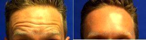 44 Year Old Man Treated With Botox By Dr. Brian Arslanian, MD, Atlanta Plastic Surgeon 395