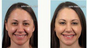 44 Year Old Woman Treated With Botox And Restylane For Crow's Feet By Doctor John Mesa, MD, New York Plastic Surgeon
