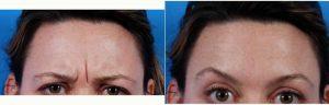 44 Year Old Woman Treated With Botox By Dr. Bhupesh Vasisht, MD, Voorhees Plastic Surgeon