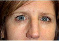 44 Year Old Woman Treated With Botox By Dr. Leonard Miller, MD, Brookline Plastic Surgeon