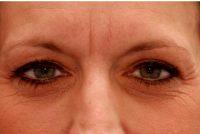 44 Year Old Woman Treated With Juvederm With Dr Stephen Weber, MD, FACS, Denver Facial Plastic Surgeon