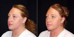 44 Year Old Woman Treated With Restylane Before & After By Dr Landon Pryor, MD, FACS, Rockford Plastic Surgeon