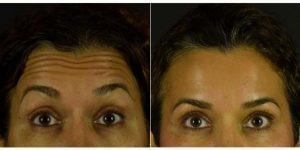 45 Year Old Woman Treated With Botox By Doctor Kian Karimi, MD, FACS, Los Angeles Facial Plastic Surgeon