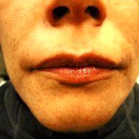 45 Year Old Woman Treated With Juvederm By Doctor Benjamin Gonzalez, MD, Silver Spring Emergency Medicine Physician