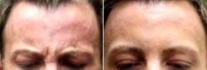 46 Year Old Man Treated With Botox Before And After With Doctor Jody A. Levine, MD, New York Dermatologic Surgeon