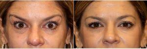 46 Year Old Woman Treated With Botox And Restylane By Doctor Mark Anton, MD, FACS, Newport Beach Plastic Surgeon