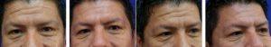 47 Year Old Male Treated For Horizontal Forehead Lines By Dr Jasmine Mohadjer, MD, Tampa Oculoplastic Surgeon