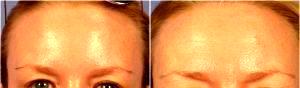 47 Year Old Woman Treated With Botox Before And After By Dr Bryson G. Richards, MD, Las Vegas Plastic Surgeon