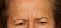 47 Year Old Woman Treated With Botox By Dr Douglas Wu, MD, San Diego Dermatologist