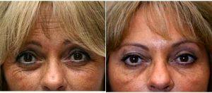 47 Year Old Woman Treated With Botox With Dr. Richard H. Bensimon, MD, Portland Plastic Surgeon