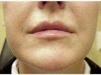 47 Year Old Woman Treated With Restylane Silk With Doctor Deborah Sherman, MD, Nashville Oculoplastic Surgeon