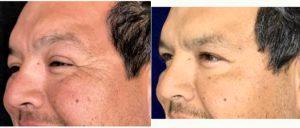 48 Year Old Man Treated With Botox With Doctor Elizabeth Hernandez Cardona, MD, San Antonio Physician