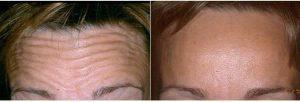 48 Year Old Woman Treated With Botox With Doctor Richard Ort, MD, Lone Tree Dermatologic Surgeon
