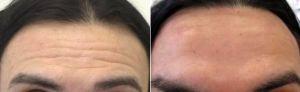 49 Year Old Man Treated With Botox And Restylane With Dr. Benjamin Barankin, MD, FRCPC, Toronto Dermatologic Surgeon