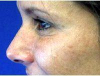 49 Year Old Woman Treated With Botox