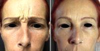 49 Year Old Woman Treated With Botox In The 11 Lines By Dr. Sandip Jain, FRCS, India Plastic Surgeon