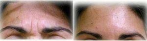 49 Year Old Woman Treated With Botox With Doctor Jeff Angobaldo, MD, Dallas Plastic Surgeon