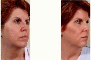49 Year Old Woman Treated With Botox With Doctor Vincent N. Zubowicz, MD, Atlanta Plastic Surgeon