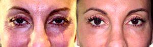 49 Year Old Woman Treated With Botox With Dr James R. Gordon, MD, FACS, FAAO, New York Oculoplastic Surgeon